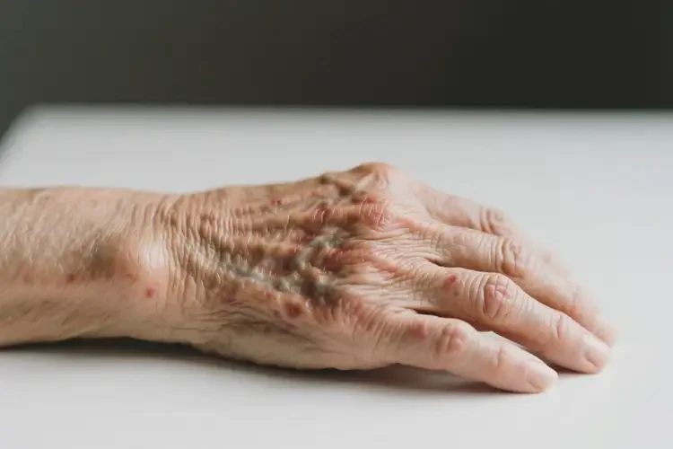 高齡老人手臂上長濕疹可不可以根治(圖4)