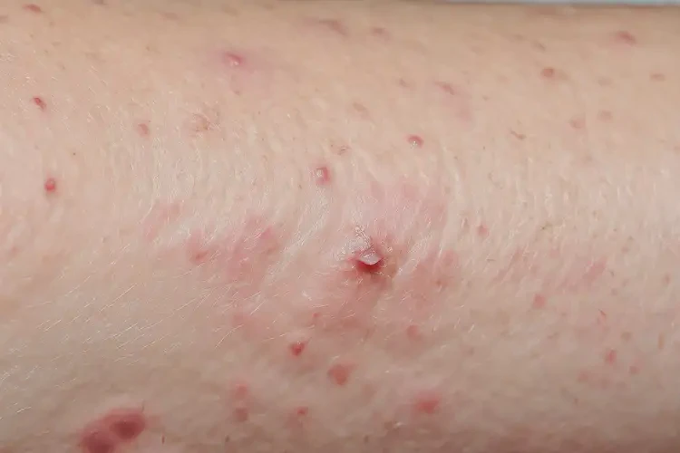 小孩身上偶爾起濕疹可不可以根治(圖4)