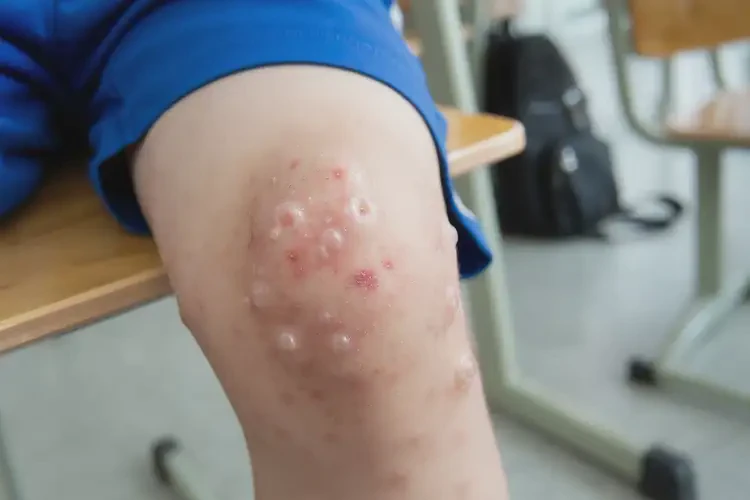 小学生小腿偶尔起湿疹可不可以根治(图4)