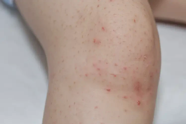 小學(xué)生大腿長(zhǎng)濕疹能夠徹底治愈嗎(圖4)