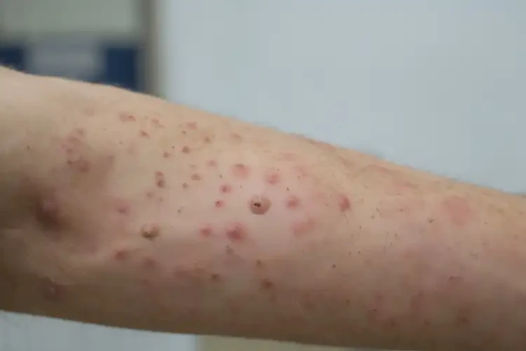 大學(xué)生手臂上出現(xiàn)濕疹不管它會自己痊愈嗎(圖3)