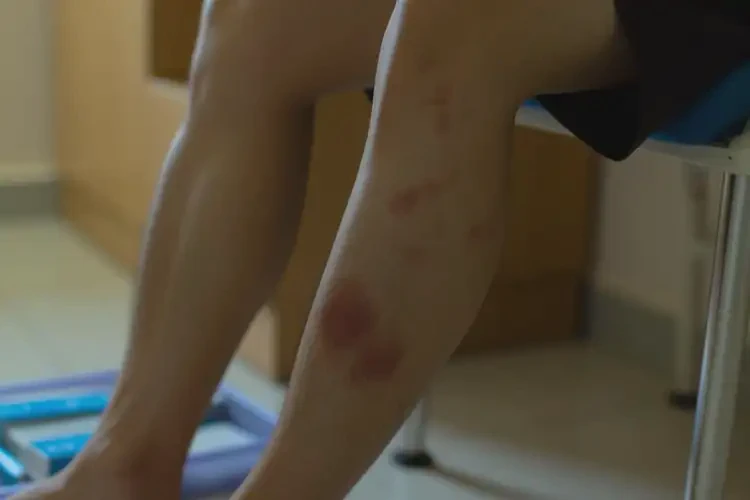 男人小腿有濕疹可不可以根治(圖4)