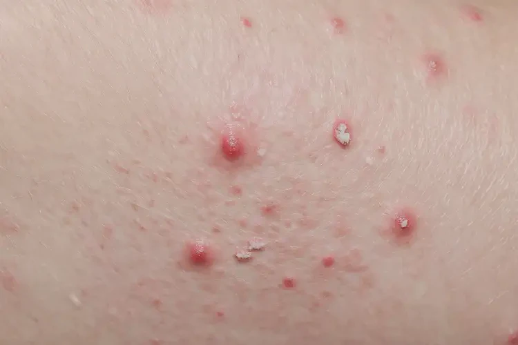 男性大腿經(jīng)常起濕疹能靠自己自愈嗎(圖4)