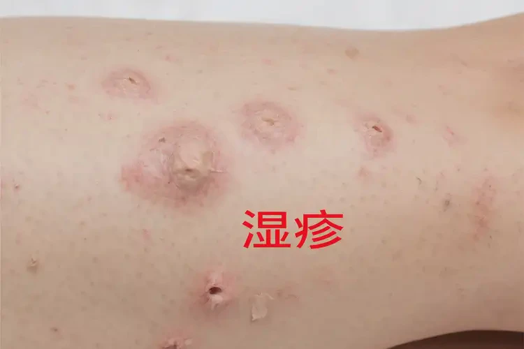 男性大腿上出濕疹可不可以根治(圖4)