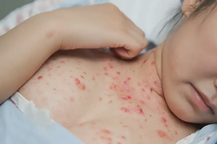 產(chǎn)婦脖子起濕疹可不可以根治(圖4)