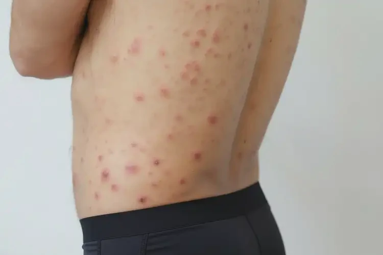 青年人屁股上經(jīng)常起濕疹可不可以根治(圖3)