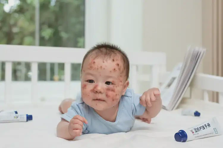 寶寶脖子上偶爾長濕疹可不可以根治(圖4)