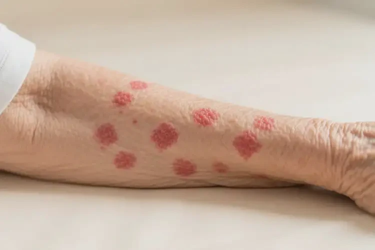 老年人手臂容易長濕疹可不可以根治(圖4)