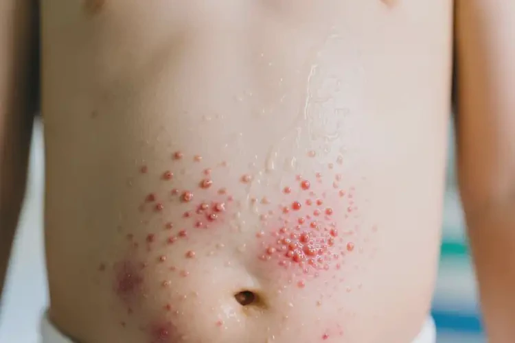 小孩肚子上出現(xiàn)濕疹可不可以根治(圖1)