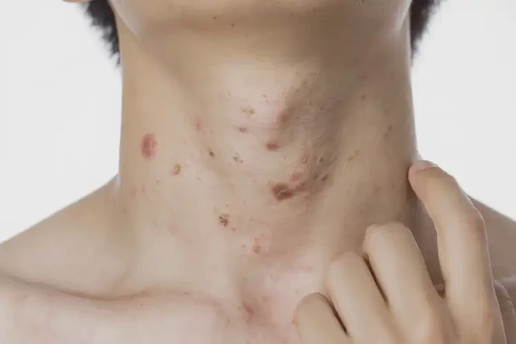 青少年脖子上容易長濕疹可不可以根治(圖4)