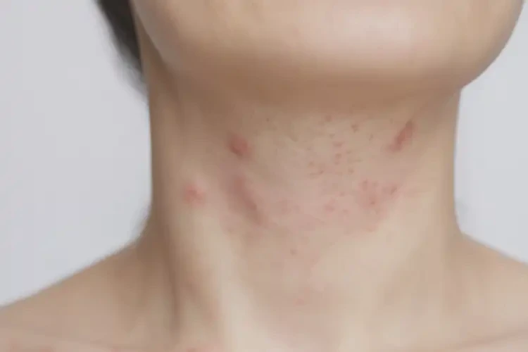 中學(xué)生脖子上有濕疹可不可以根治(圖4)