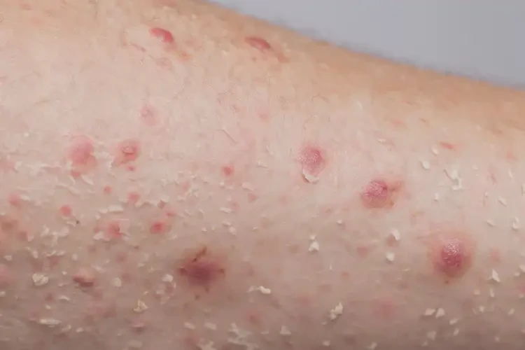 大學生腳上偶爾起濕疹不管它會自己好嗎(圖3)