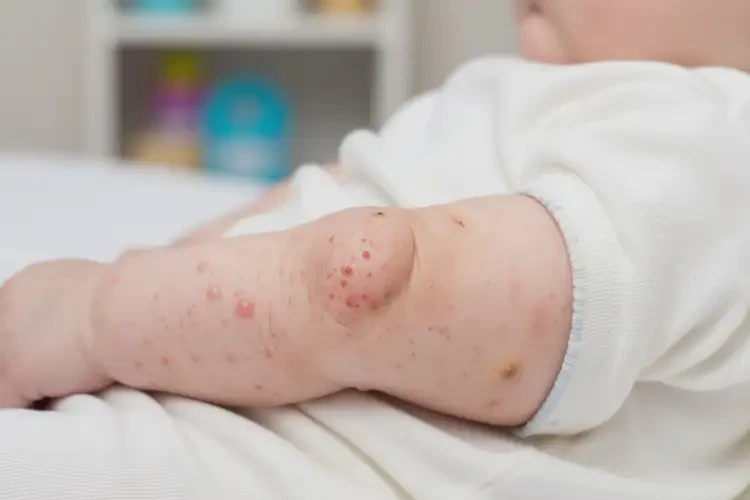 嬰幼兒小腿容易長濕疹不管它會自己好嗎(圖1)