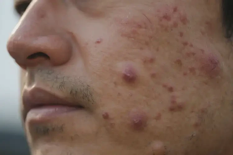 男人全身有濕疹不管它會自己自愈嗎(圖4)