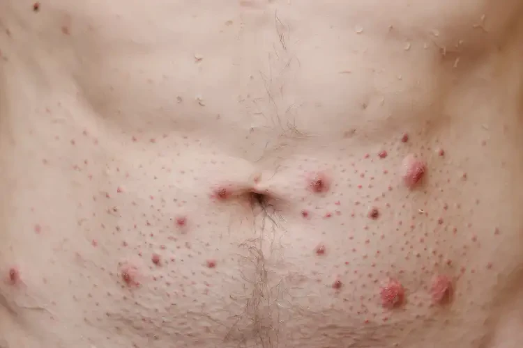 老年人肚子上出濕疹可不可以根治(圖4)