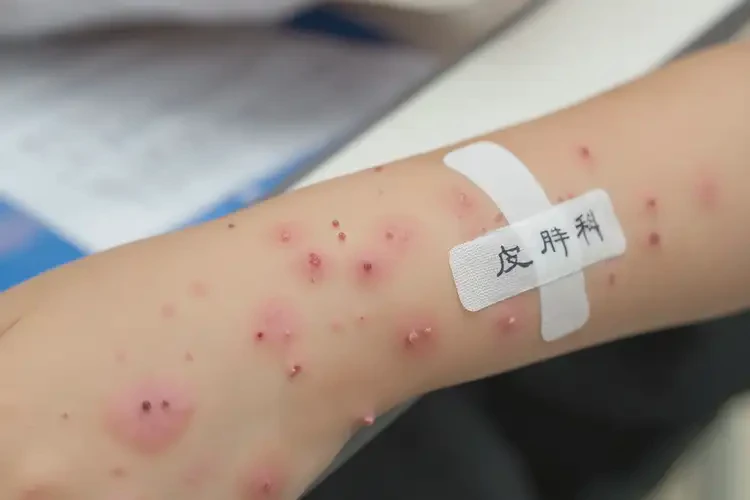 小學生手臂上偶爾起濕疹可不可以根治(圖4)