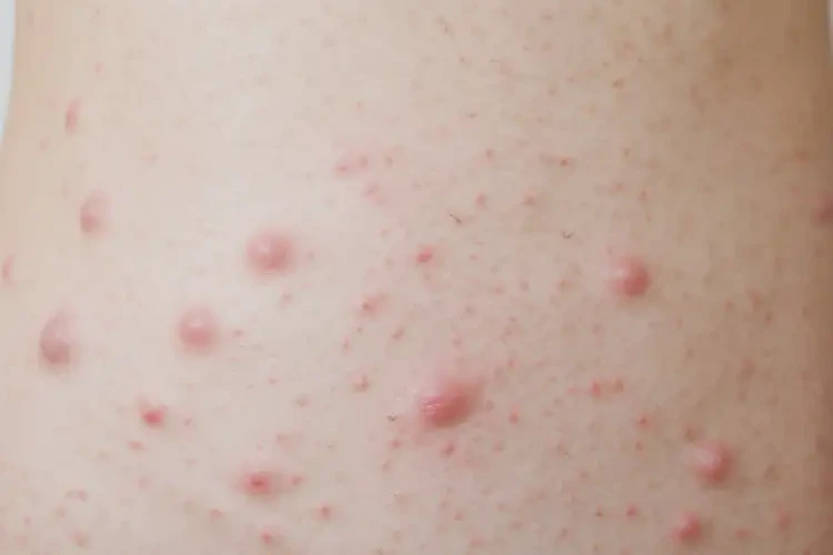 女生屁股容易長濕疹可不可以根治(圖3)