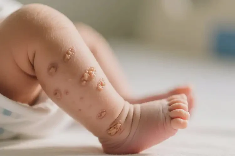 新生兒小腿容易起濕疹可不可以根治(圖4)
