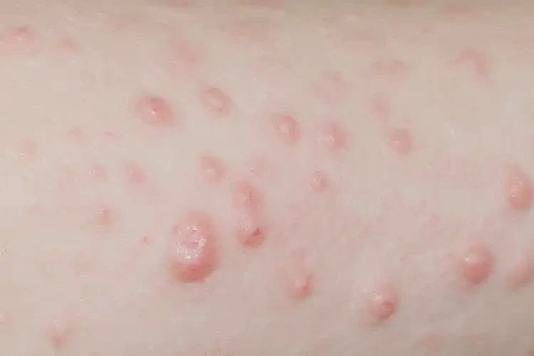 女人大腿容易長濕疹能徹底自愈嗎(圖4)