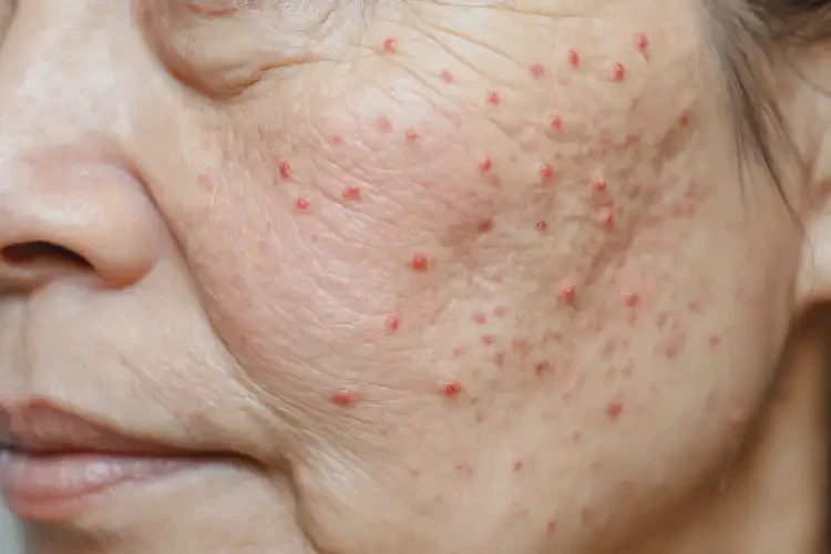 孩子肚子上长湿疹可不可以根治(图4)