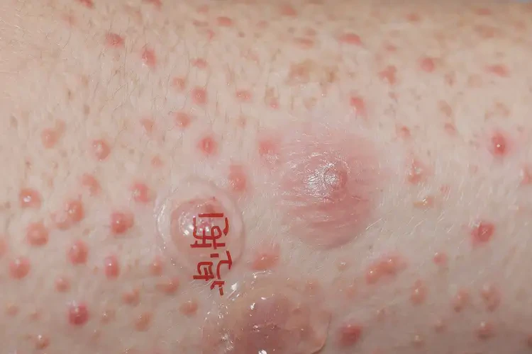 大學(xué)生脖子偶爾起濕疹可不可以根治(圖4)