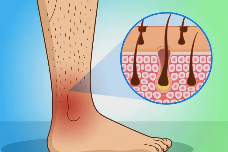 男生小腿上容易起濕疹可不可以根治(圖1)