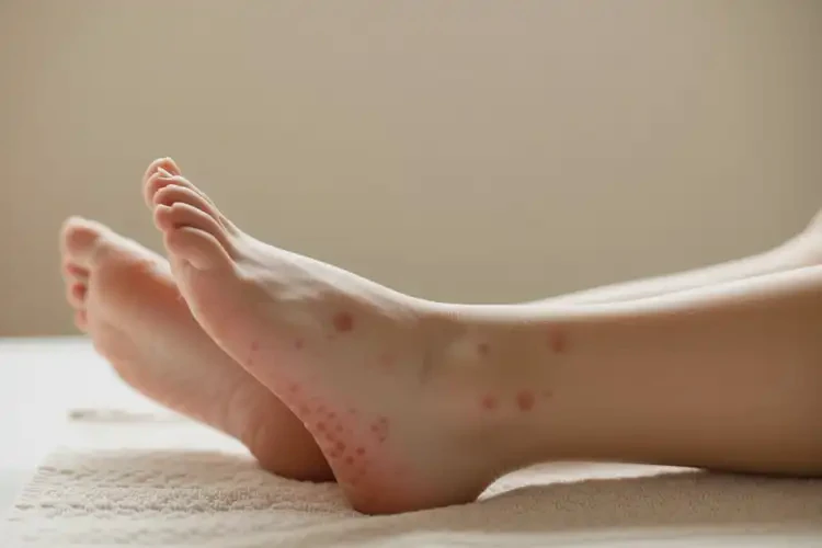 產(chǎn)婦腳上經(jīng)常長濕疹可不可以根治(圖4)