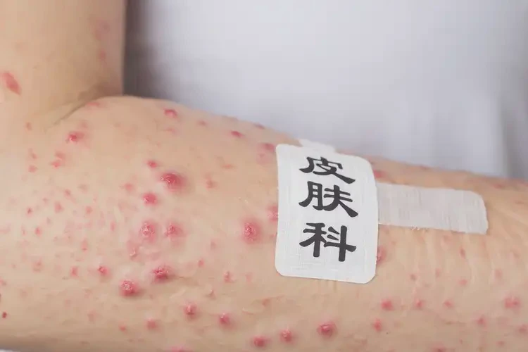 女性手臂經(jīng)常長(zhǎng)濕疹可不可以根治(圖4)