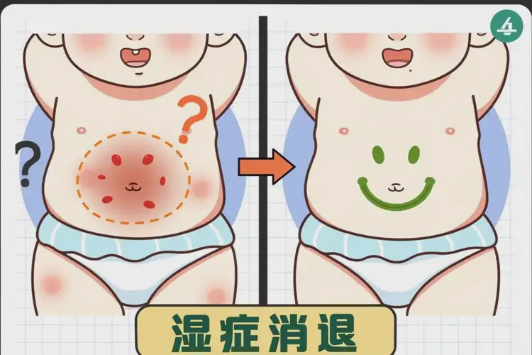 小儿肚子上长湿疹可不可以根治(图4)
