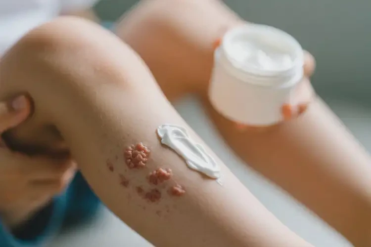 兒童小腿經(jīng)常起濕疹可不可以根治(圖1)