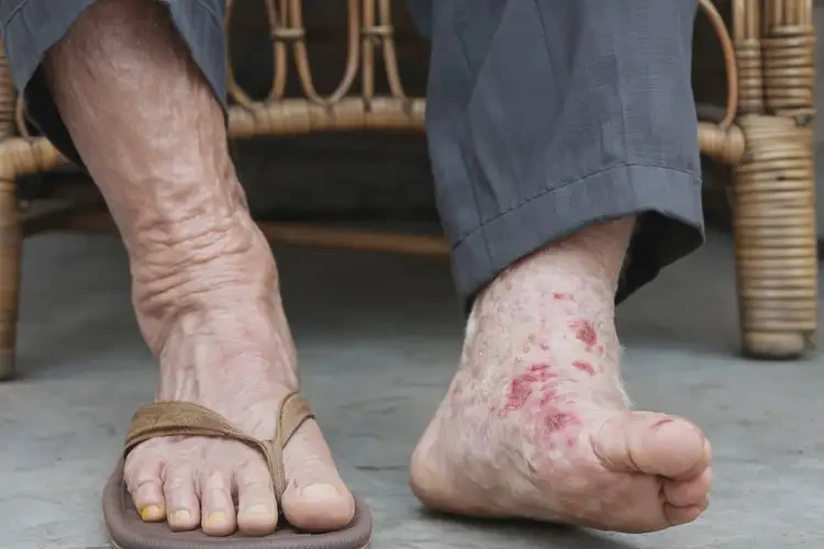 高齡老人腳上經(jīng)常起濕疹能不能徹底自愈(圖4)