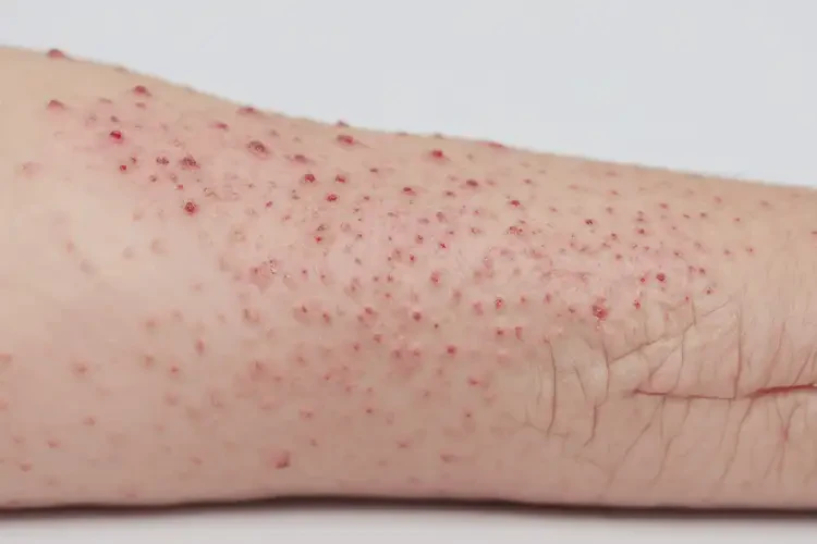 孩子手臂上偶爾起濕疹可不可以根治(圖4)