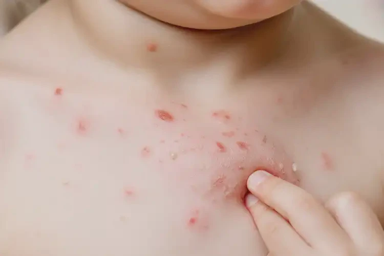 少兒脖子偶爾長濕疹可不可以根治(圖4)