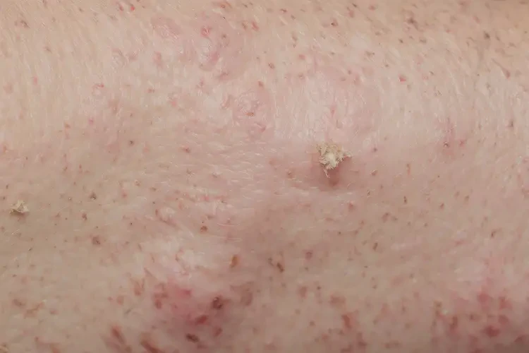 男人身上出現(xiàn)濕疹可不可以徹底自愈(圖3)