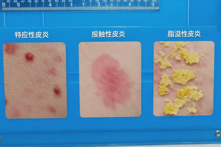 女性大腿容易起濕疹能靠自己自愈嗎(圖3)