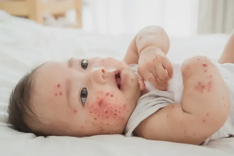 寶寶身上出濕疹可不可以根治(圖4)