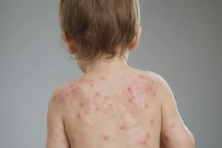 幼兒全身容易起濕疹可以徹底自愈嗎(圖4)
