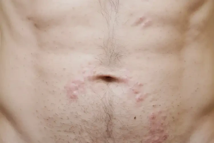 男性肚子偶尔长湿疹能彻底自愈吗(图4)