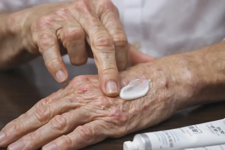 高齡老人手上出濕疹能不能根治(圖3)