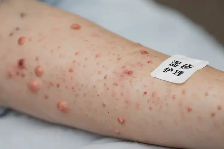 青少年手臂起濕疹能不能徹底自愈(圖4)