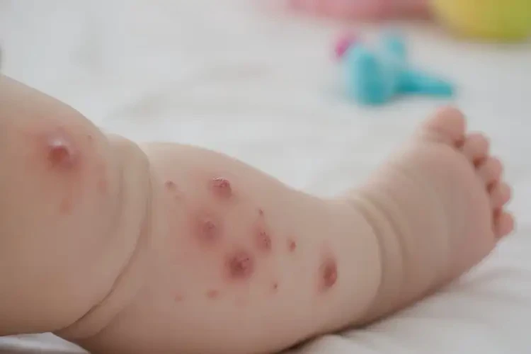 寶寶大腿長(zhǎng)濕疹不管它會(huì)自己好嗎(圖4)