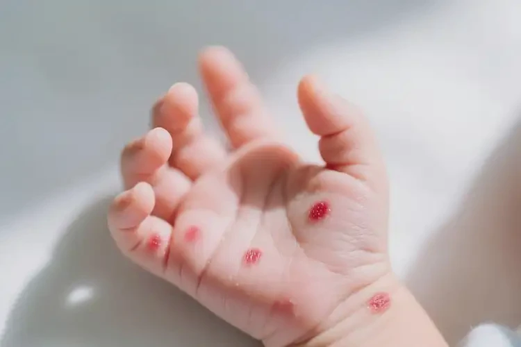 新生儿手上偶尔长湿疹可不可以根治(图3)