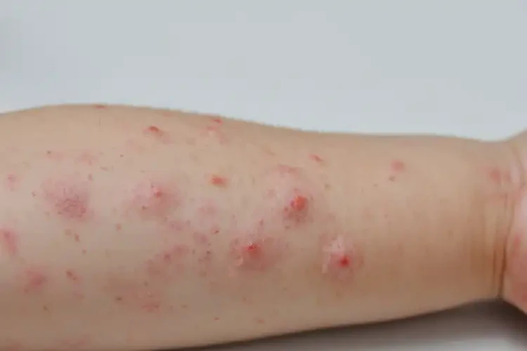 兒童手臂上容易起濕疹能靠自己自愈嗎(圖3)