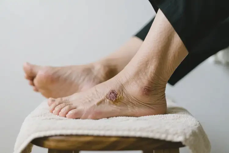 老年人脚上容易起湿疹可不可以根治(图2)