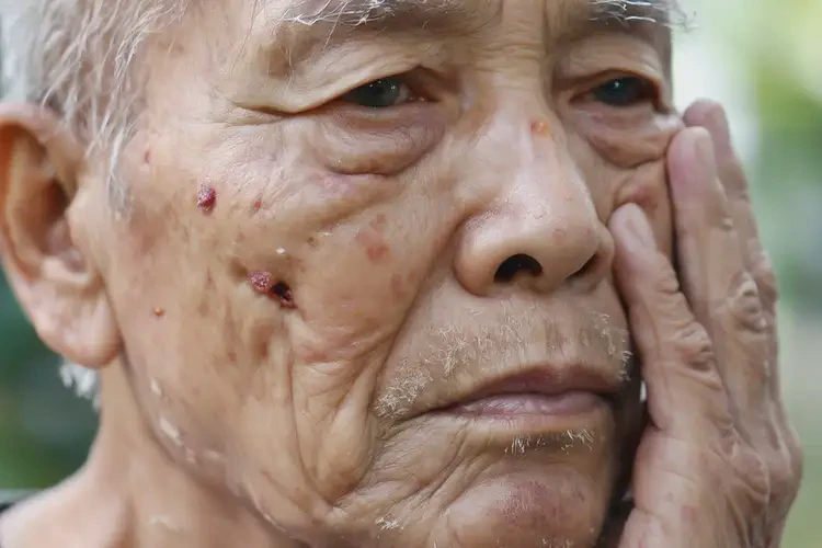 高龄老人脸上容易起湿疹能不能根治(图4)