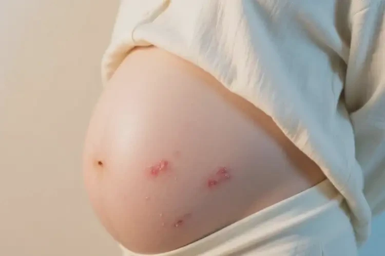 孕婦身上偶爾起濕疹可不可以根治(圖3)