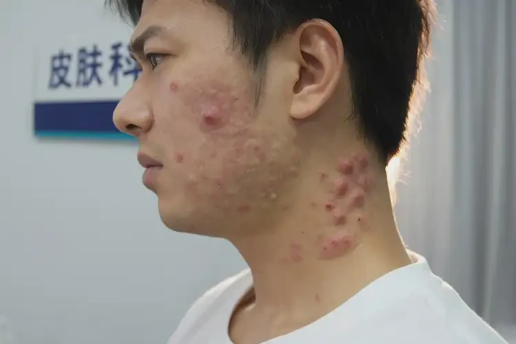 青年人脖子经常起湿疹可不可以根治(图4)