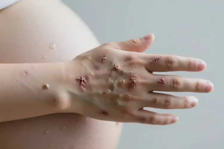 孕婦手上偶爾長濕疹可不可以根治(圖3)
