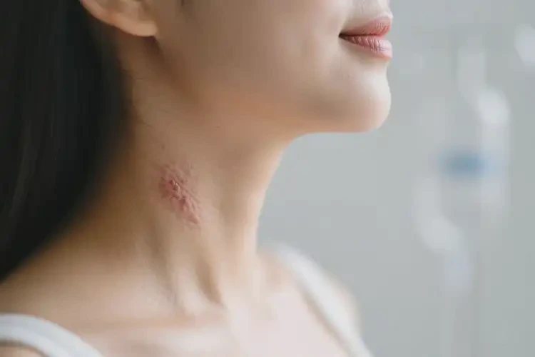 孕婦脖子上有濕疹可不可以根治(圖1)