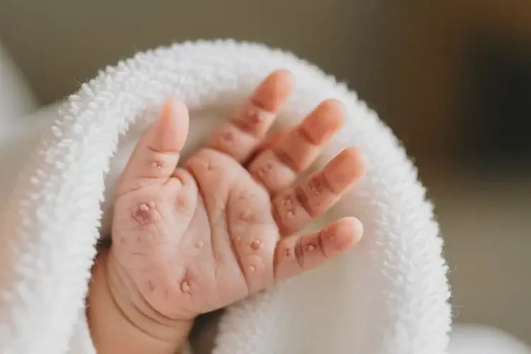 寶寶手上長濕疹可以治好嗎(圖3)